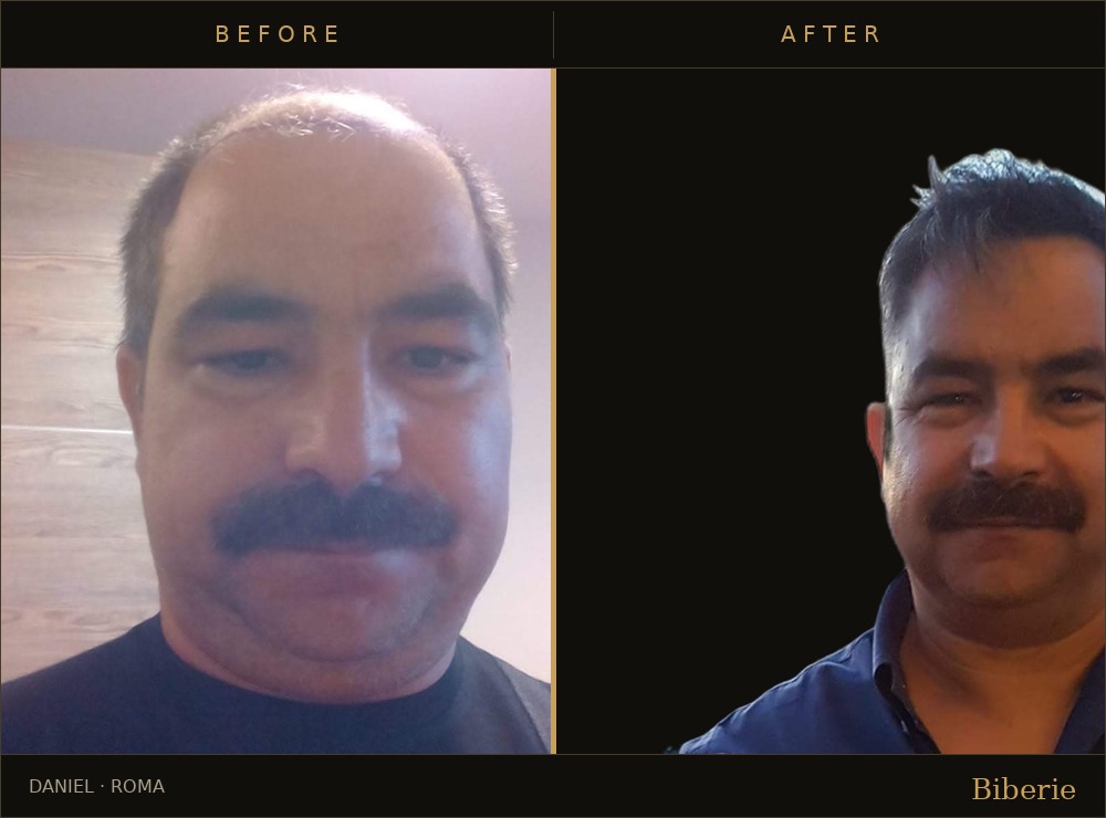 Facial rejuvenation consultation