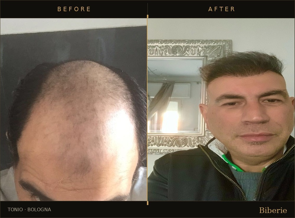 Rhinoplasty patient post-operative consultation