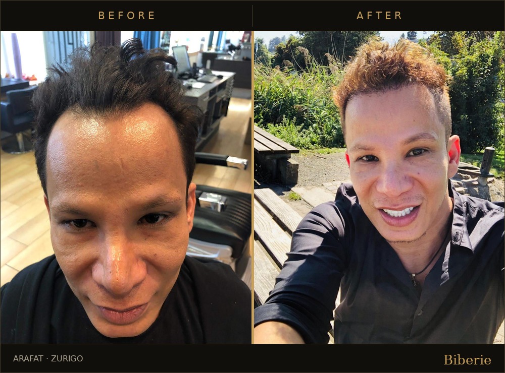 Hair transplant results progression