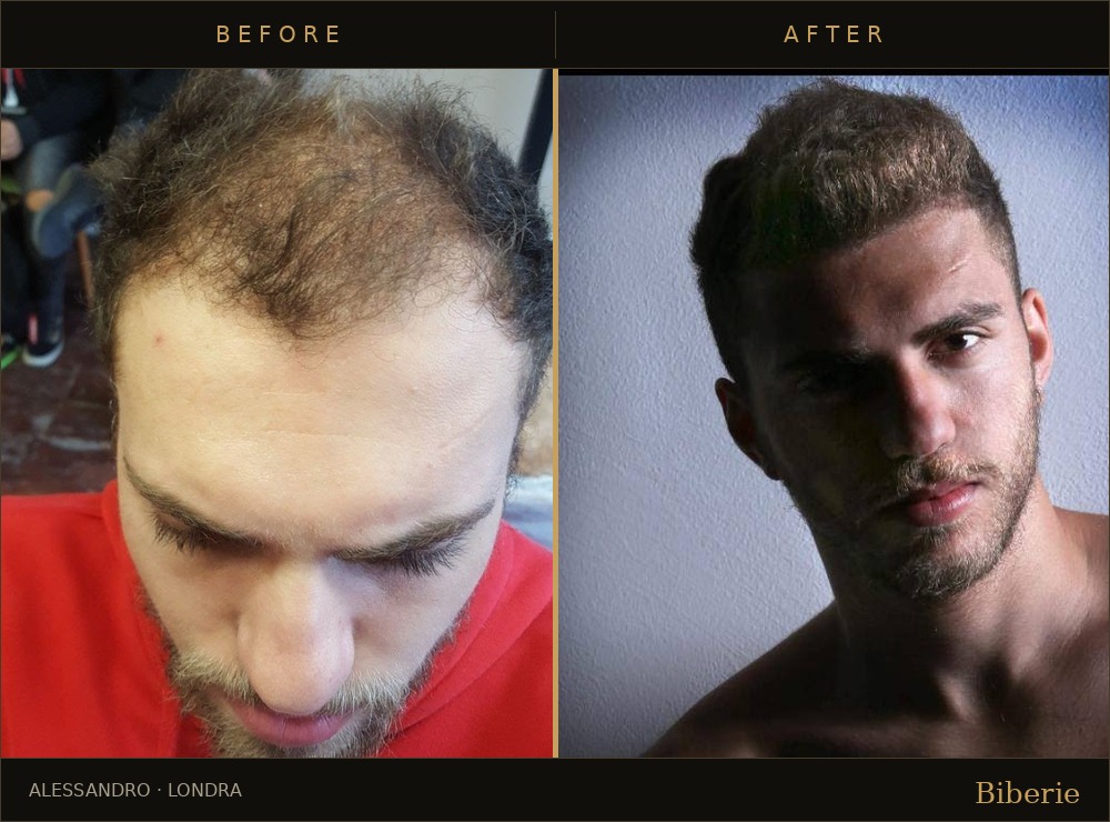 Hair transplant before and after — Alessandro, Londra