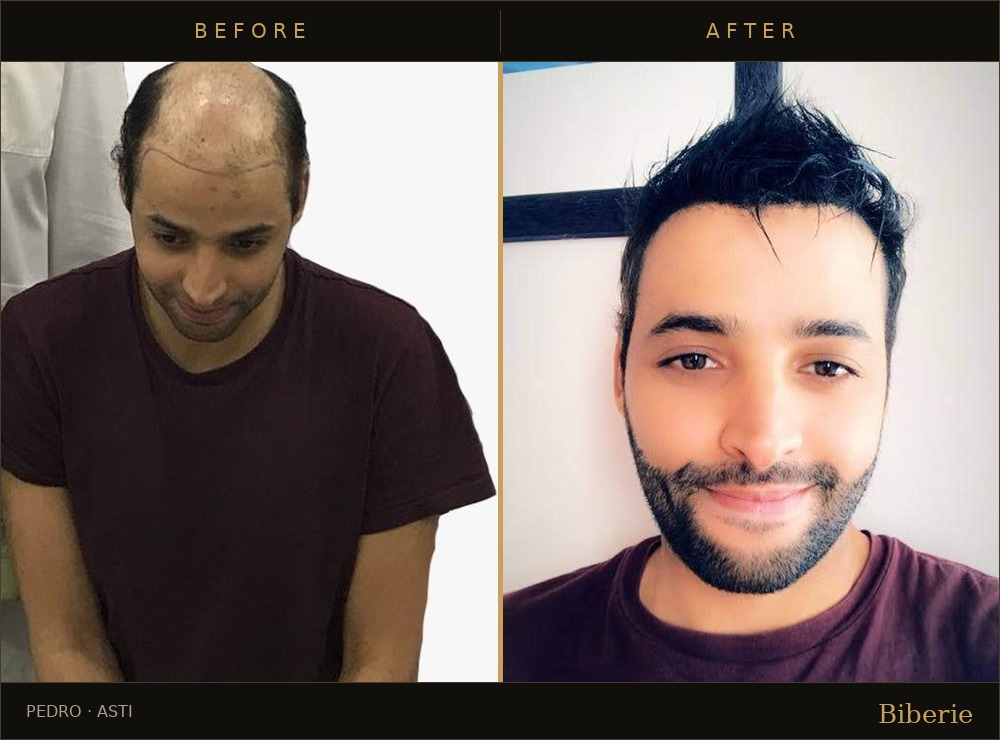Hair transplant before and after — Pedro, Asti