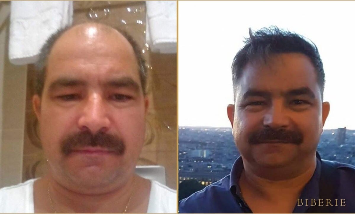 Hair restoration — lived-in result